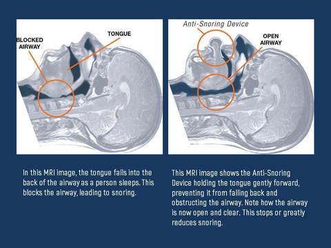 Apnea Tongue Stabilizing Device - Coldesk