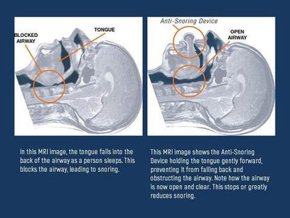 Apnea Tongue Stabilizing Device - Coldesk