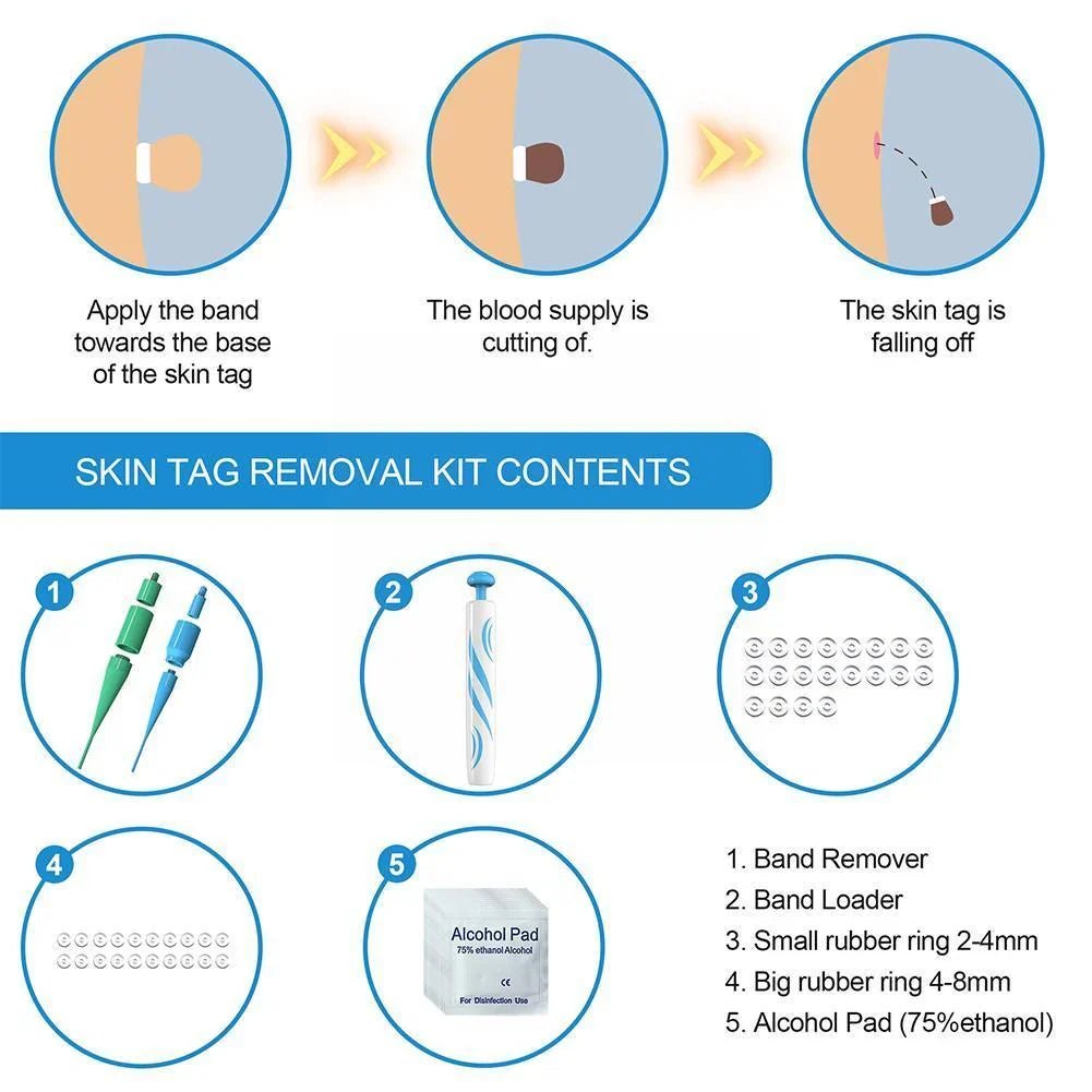 Auto Skin Tag Remover Painless - Coldesk