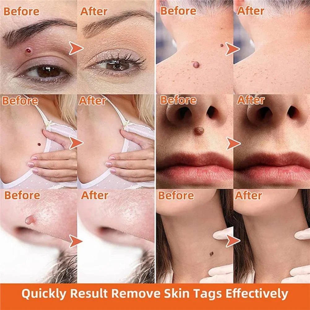 Auto Skin Tag Remover Painless - Coldesk