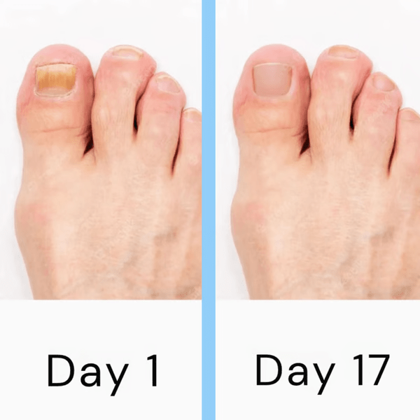 Nail Laser Fungus Device - Coldesk