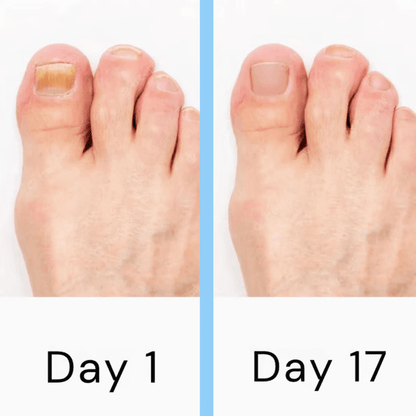 Nail Laser Fungus Device - Coldesk