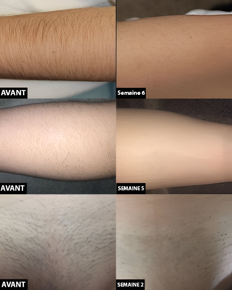 Permanent laser hair removal - Coldesk