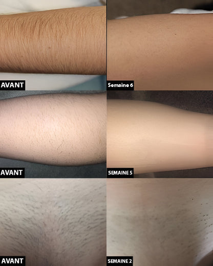 Permanent laser hair removal - Coldesk