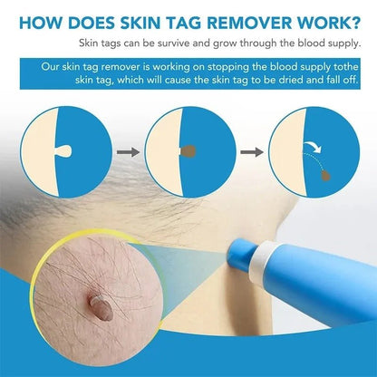 Skin Tag Removal Kit - Coldesk