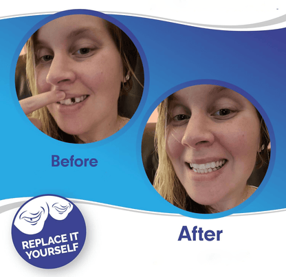 Smile Veneer (Upper & Lower Included) - Coldesk