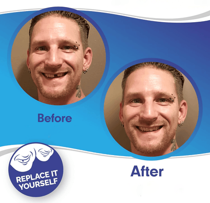 Smile Veneer (Upper & Lower Included) - Coldesk