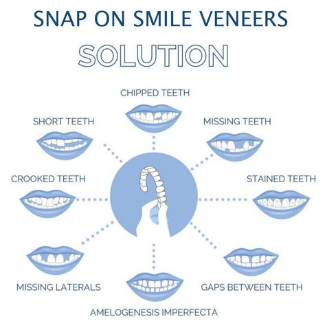 Smile Veneer (Upper & Lower Included) - Coldesk