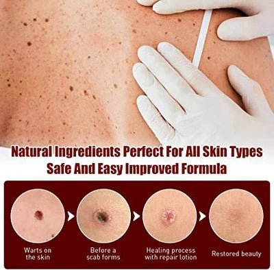 Tags & Moles Remover - Coldesk
