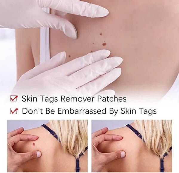 Tags & Moles Remover - Coldesk