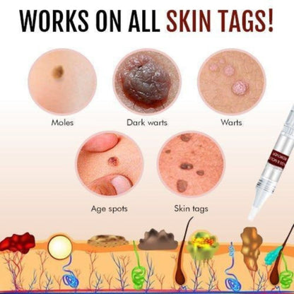Tags & Moles Remover - Coldesk